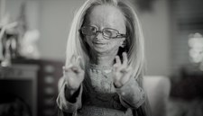 Adalia Rose zmarła w wieku 15 lat. Cierpiała na rzadką chorobę