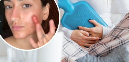 Krew menstruacyjna na niedoskonałości? Niebezpieczny trend szaleje na TikToku
