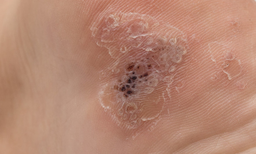 Działa niczym rasowy zabójca. Kurzajki nie mają szans