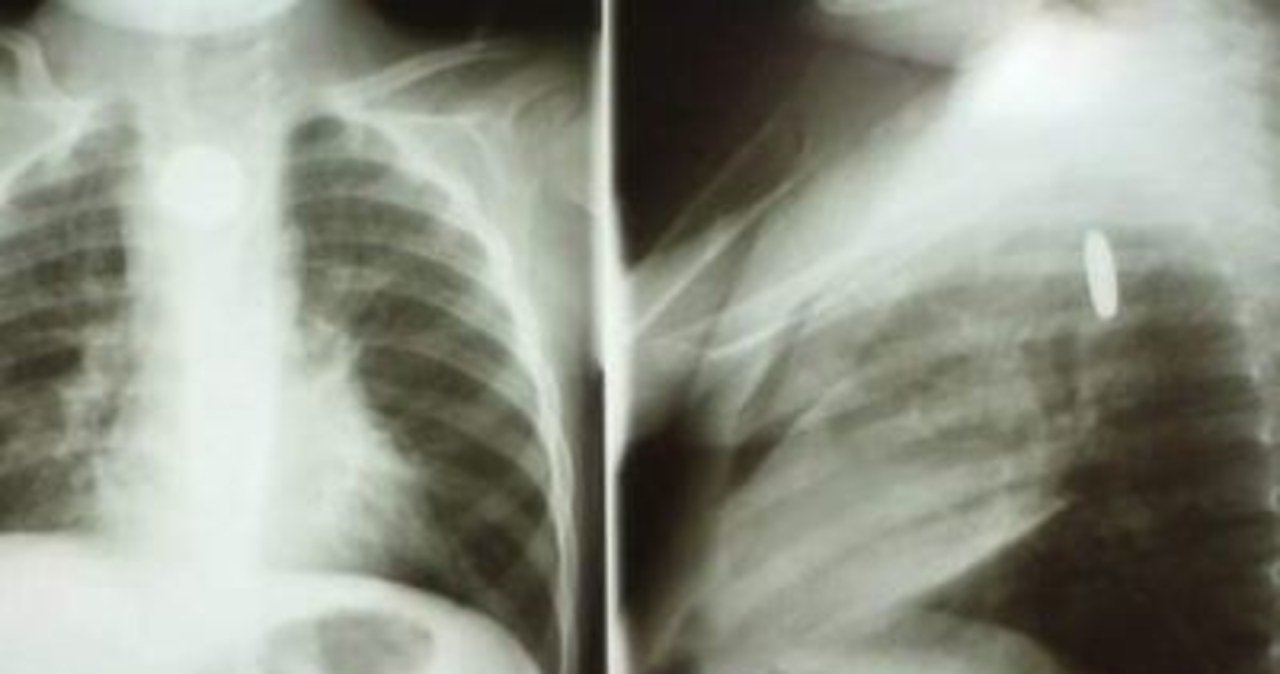 2-latek połknął baterię. Lekarze walczą o jego życie