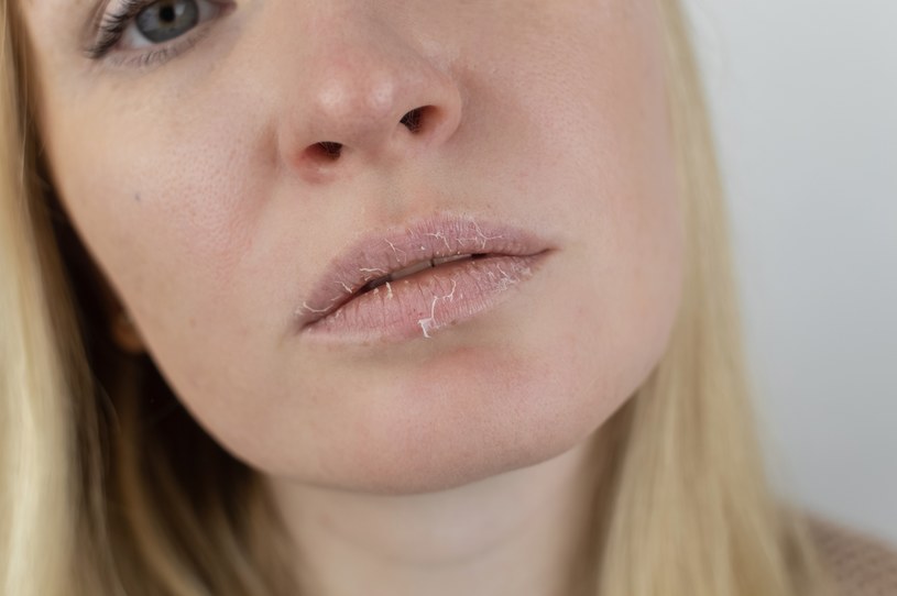 Balsam na popękane usta. Pozostaw grubą warstwę na noc, a rano problem zniknie
