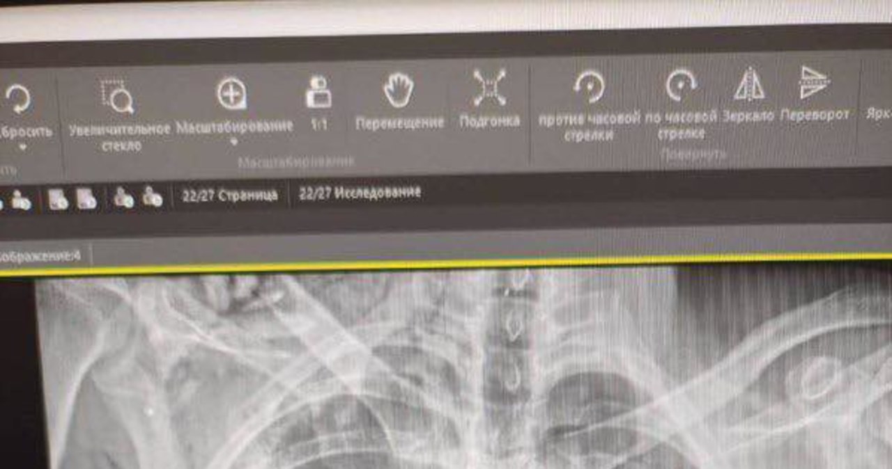 W ciele rannego utknął pocisk z granatnika, który nie eksplodował