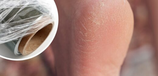 Skuteczna pielęgnacja stóp. Z pomocą przychodzi folia spożywcza