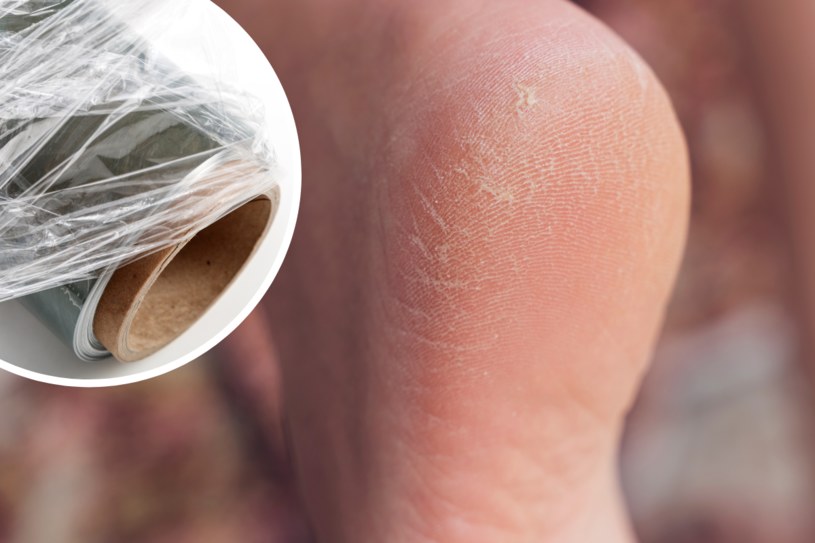 Skuteczna pielęgnacja stóp. Z pomocą przychodzi folia spożywcza