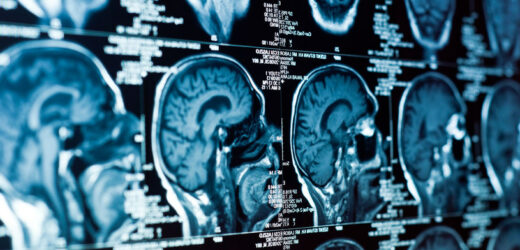 Ryzyko udaru i Alzheimera rośnie. Złe wieści dla pacjentów z bezdechem sennym