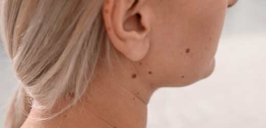 Jeden z najbardziej podstępnych nowotworów. Może rozwijać się latami