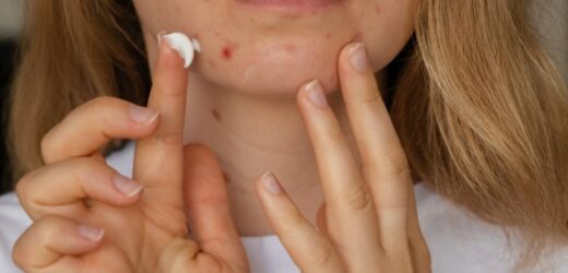 Dermatolodzy oceniają domowe sposoby na trądzik. Na które należy uważać?