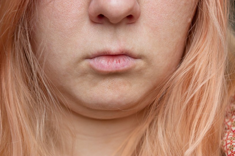 Granica między twarzą a szyją się  zaciera? Obejdzie się bez skalpela
