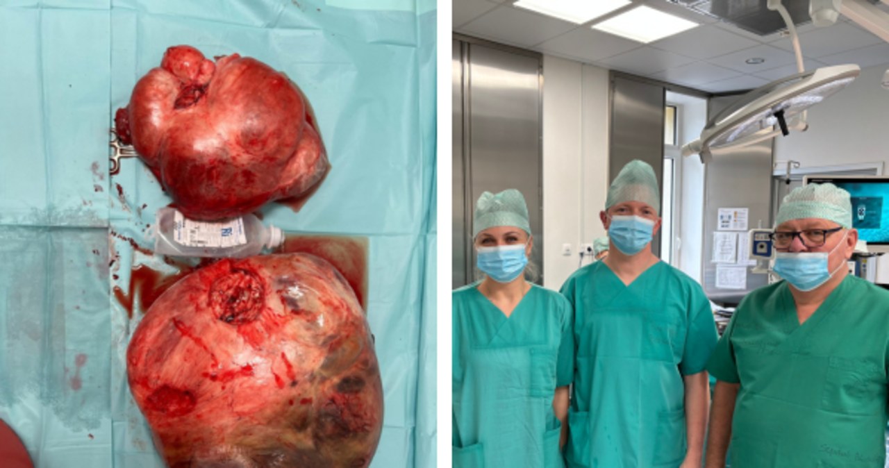 Wycięli kobiecie 26-kilogramowy guza. Ginekolog: Nie lekceważcie badań kontrolnych!