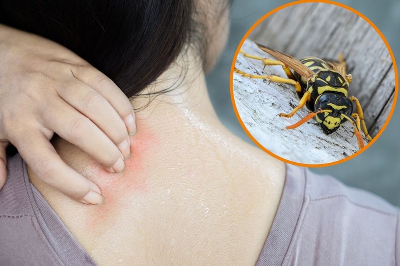 Ekspresowa mieszanka łagodząca użądlenie osy. Zamiast panikować, przemywam nią skórę