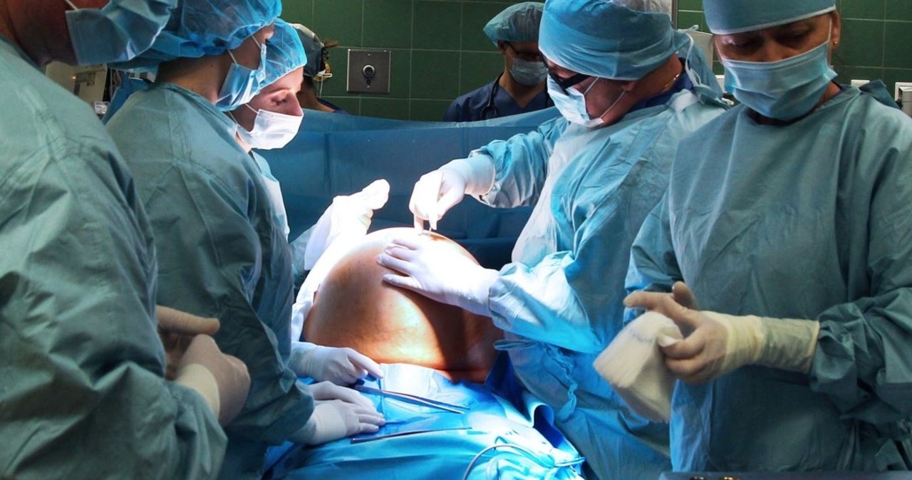 Gigantyczny guz przydatków. Miał 40 cm i ważył ponad 14 kg