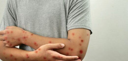 ECDC przestrzega przed wzrostem przypadków małpiej ospy