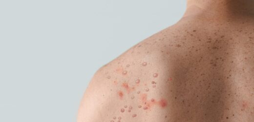 WHO uruchomiła program walki z epidemią małpiej ospy