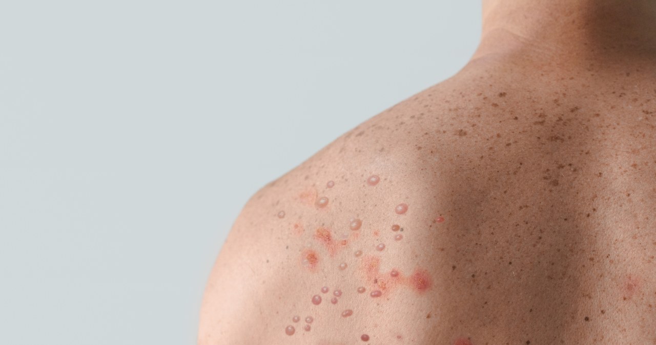 WHO uruchomiła program walki z epidemią małpiej ospy