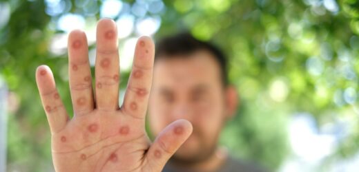 Pierwszy przypadek nowego wariantu małpiej ospy w Niemczech. Polskie służby uspokajają