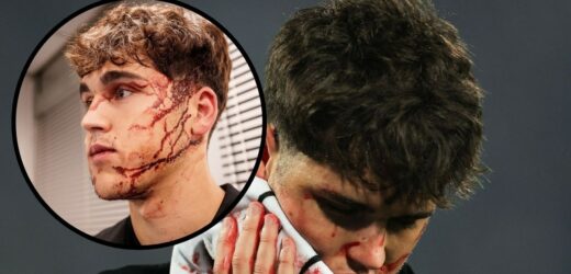 10 szwów na twarzy. Fatalna kontuzja piłkarza Barcelony