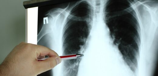 Ten MUSK może pomóc skuteczniej leczyć raka