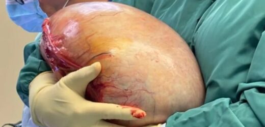 Gigantyczny guz u 23-latki. Lekarze przekazali nowe informacje