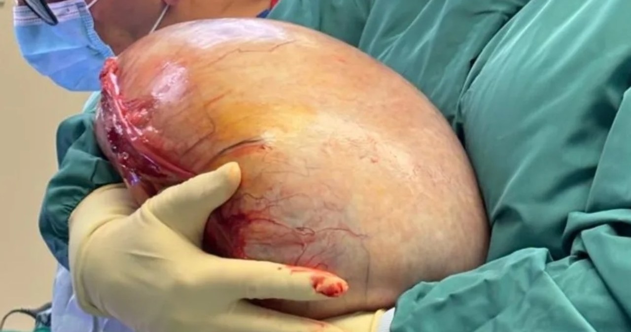 Gigantyczny guz u 23-latki. Lekarze przekazali nowe informacje